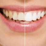 ¿Cómo conseguir una sonrisa atractiva?