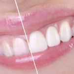 Blancorexia dental: cómo evitarla