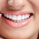 Tendencias de moda: las carillas dentales