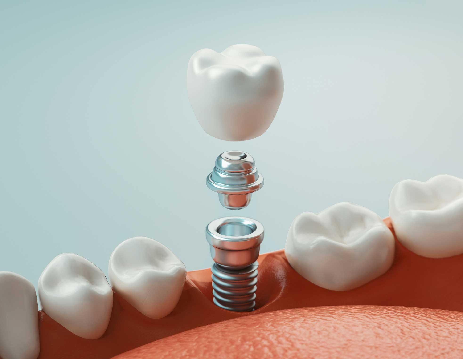 prótesis dental en Terrassa