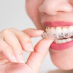 Preguntas frecuentes sobre el Invisalign