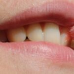 ¿Qué es la placa bacteriana?