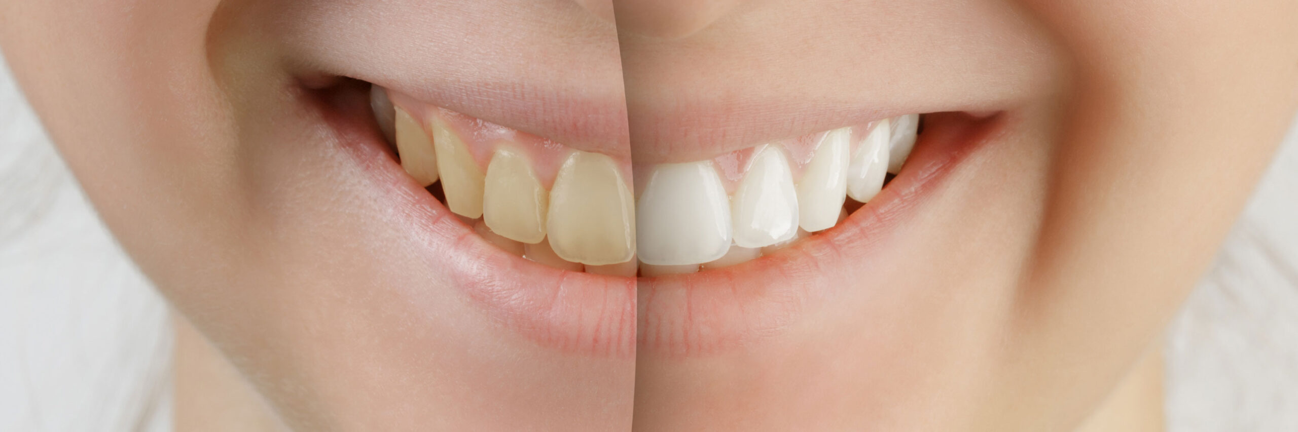 estética dental en Terrassa