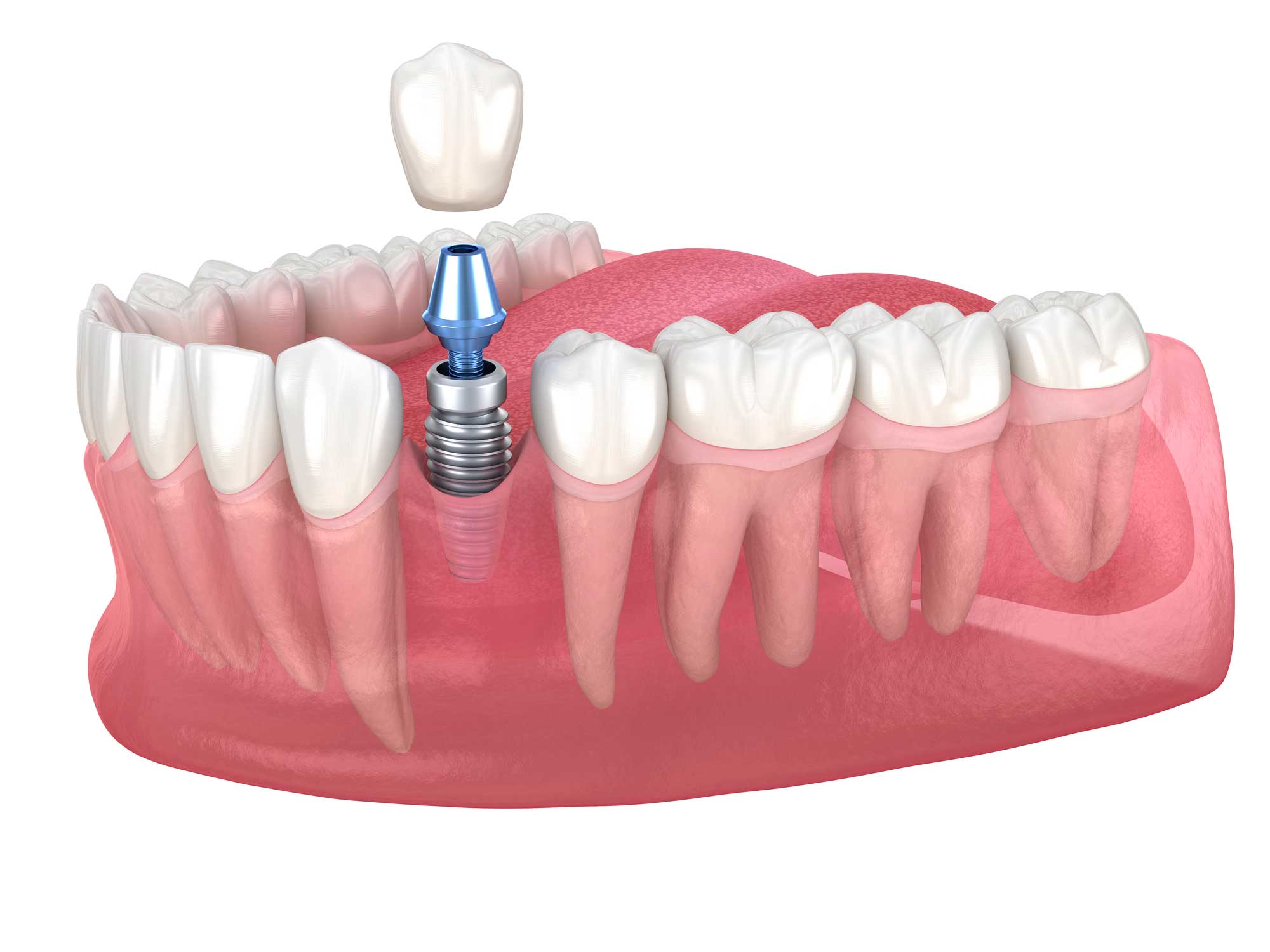 cirugía oral y maxilofacial en Terrassa