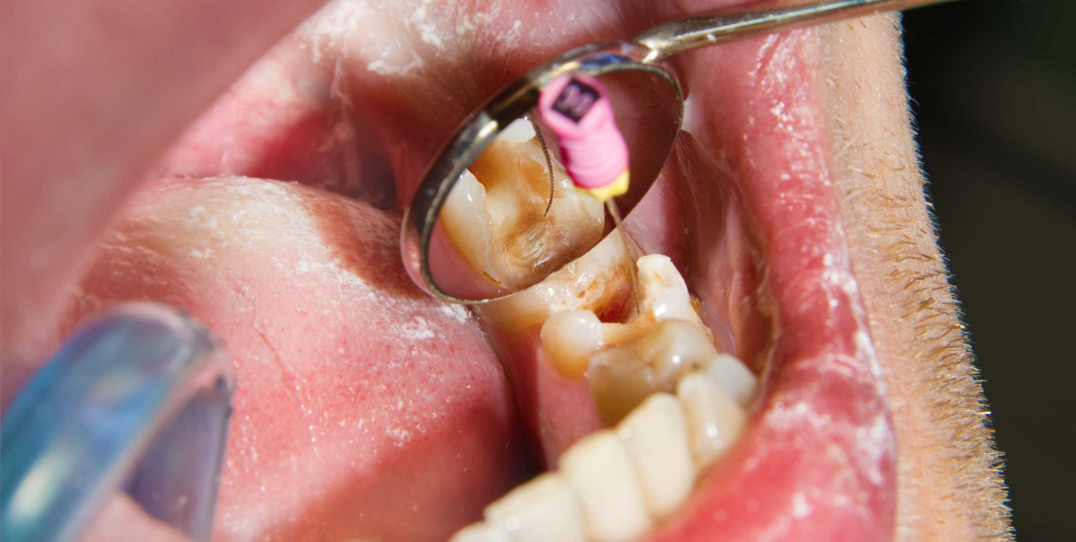 endodoncia en Terrassa