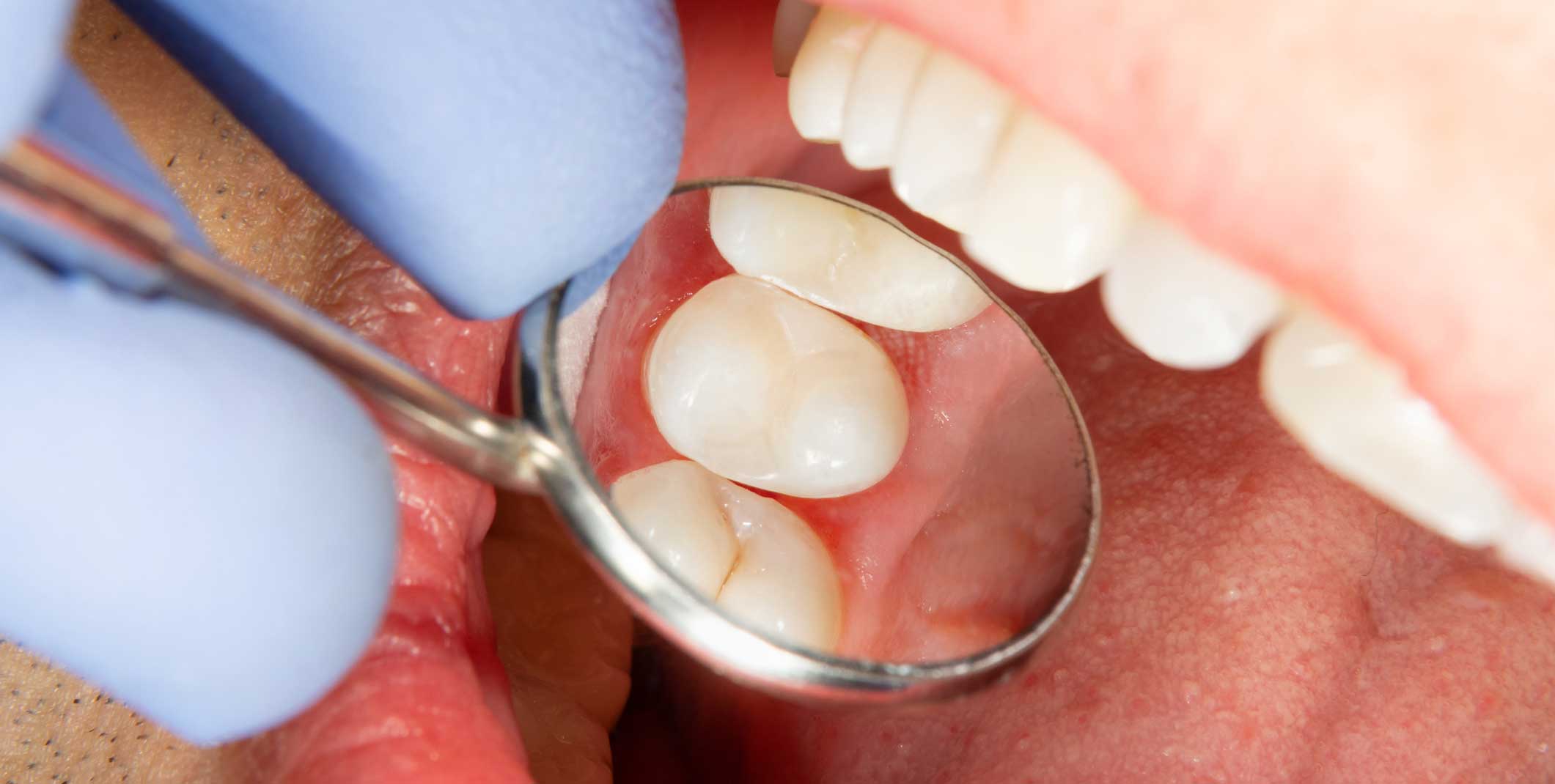 endodoncia en Terrassa