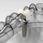Implantología dental