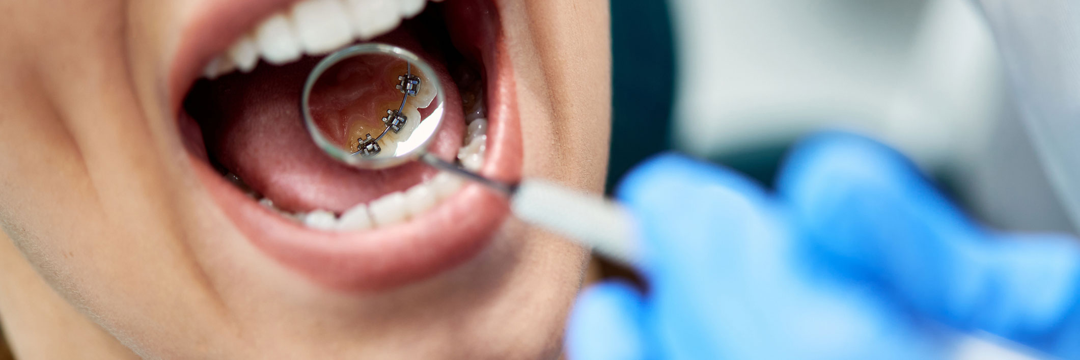 ortodoncia en Terrassa, clínica dental en Terrassa
