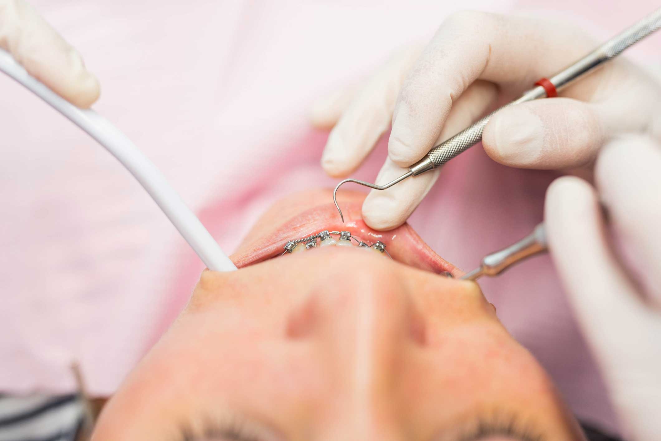 ortodoncia en Terrassa, clínica dental en Terrassa