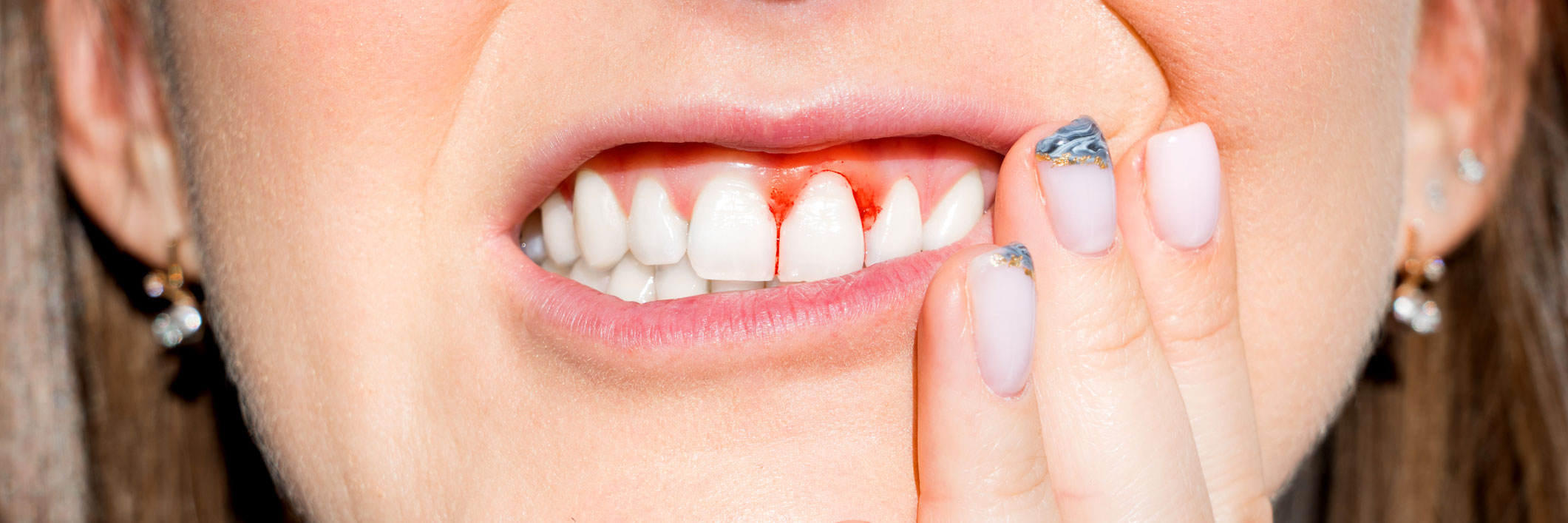 periodoncia en Terrassa